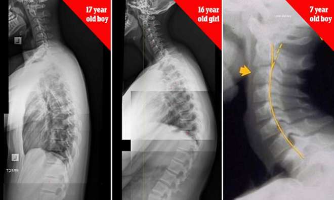 Radiografie delle persone affette da "collo da sms"