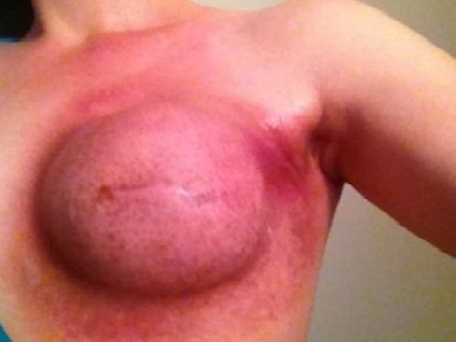 La foto della blogger mostra gli effetti del cancro al seno