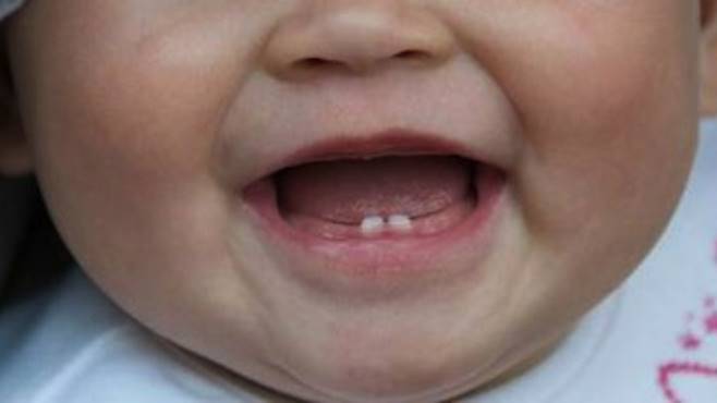 Bambina nasce con 2 denti