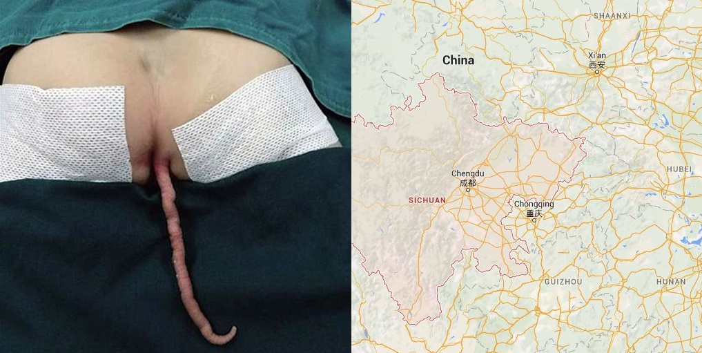Bimbo cinese nasce con la coda: operato dopo 11 mesi