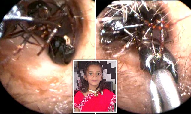 Shreya, bimba 12enne vive con u nido di formiche nell'orecchio